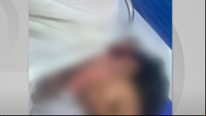 Mulher está internada no HGE para tratamento das queimaduras - Foto: Reprodução / TV Pajuçara
