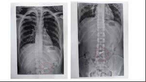 Exame de radiografia identificou o objeto no estômago do homem de 20 anos - Foto: Reprodução/PM-MG